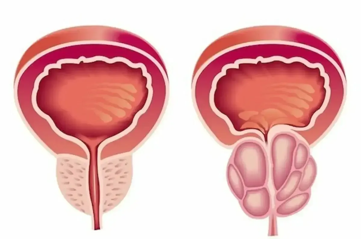 Sund prostata sammenlignet med betændt prostata