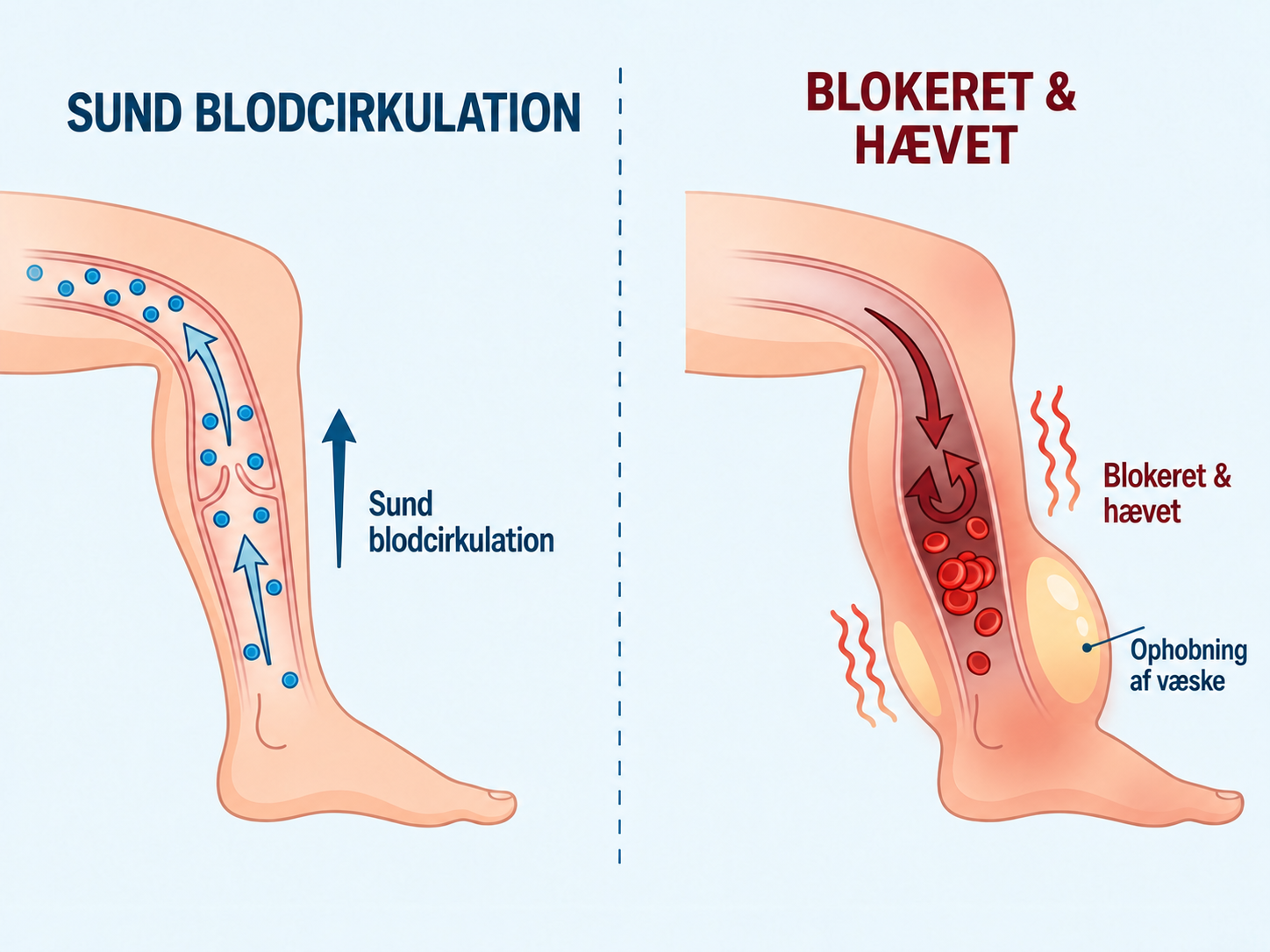 Diagram over sund cirkulation og blokeret væske