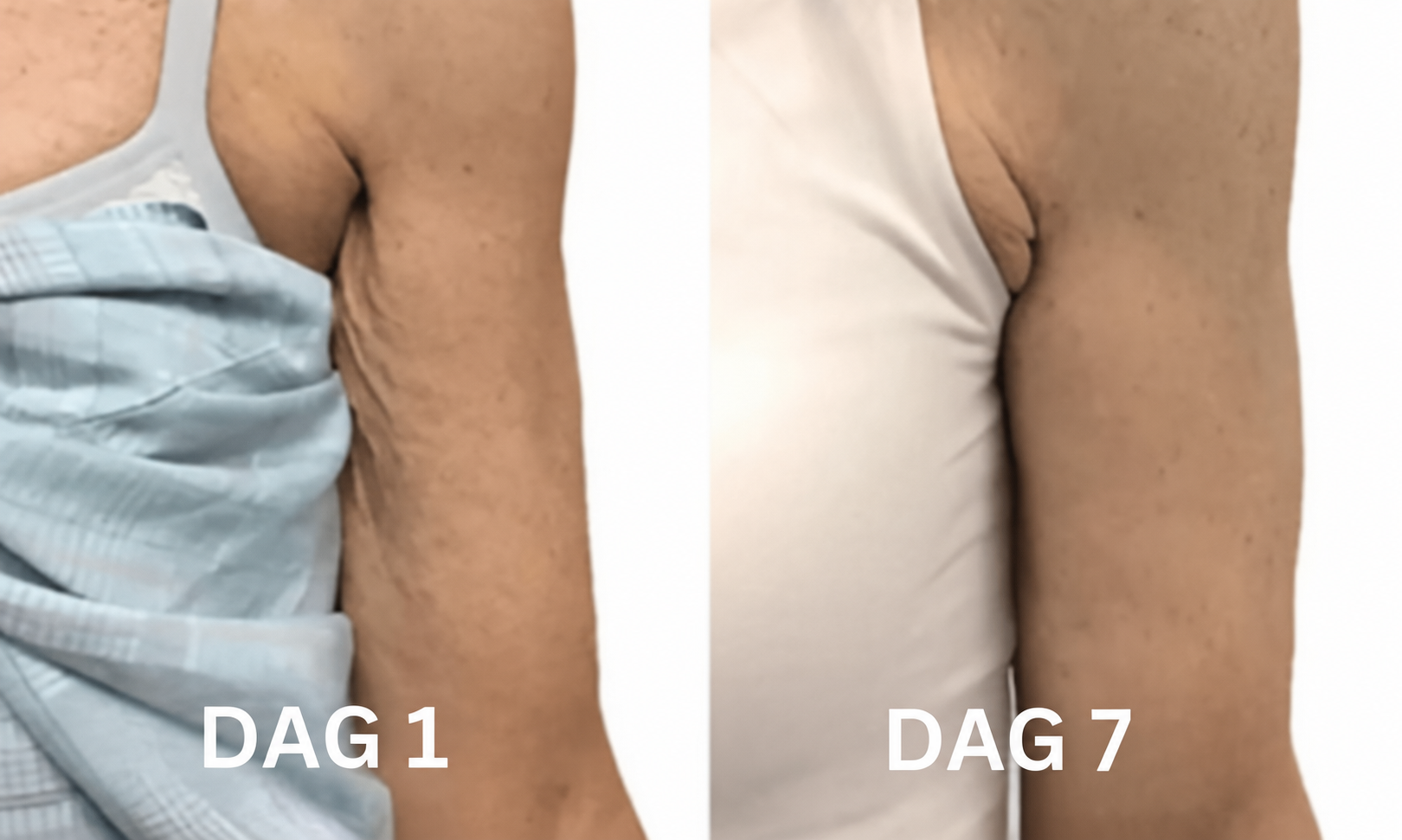 Dag 1 og dag 7 – overarme