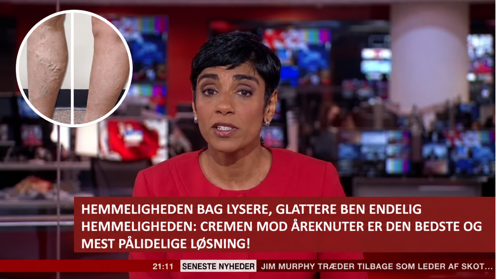Tv-indslag om åreknuder