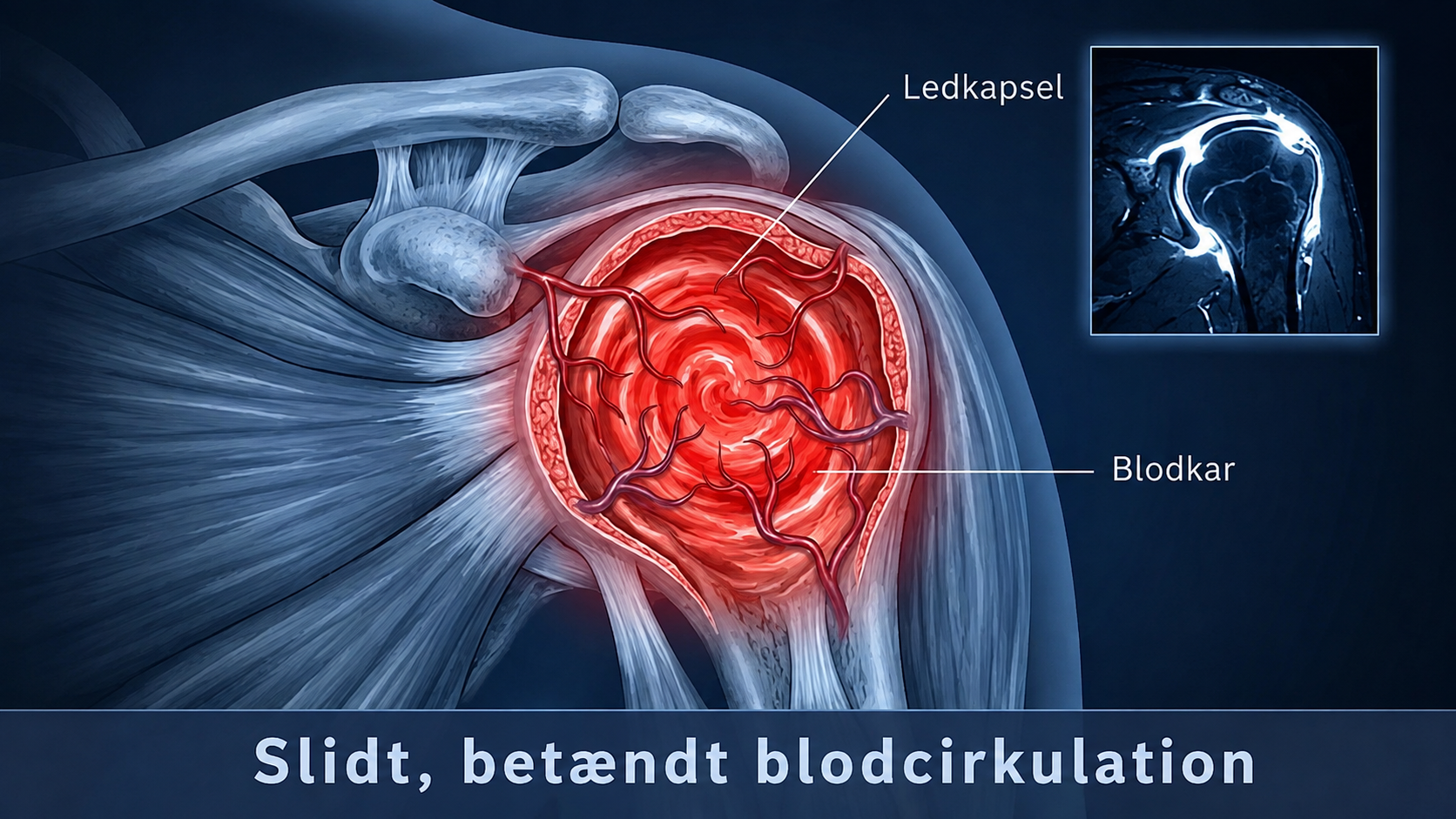 Inflammation og forstyrret blodcirkulation i skulderen
